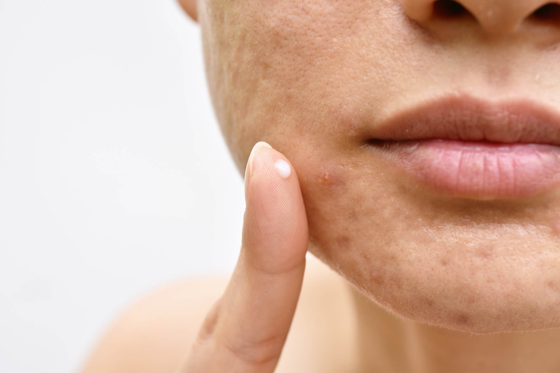 Integratori Naturali: Prevenire ed eliminare l'Acne